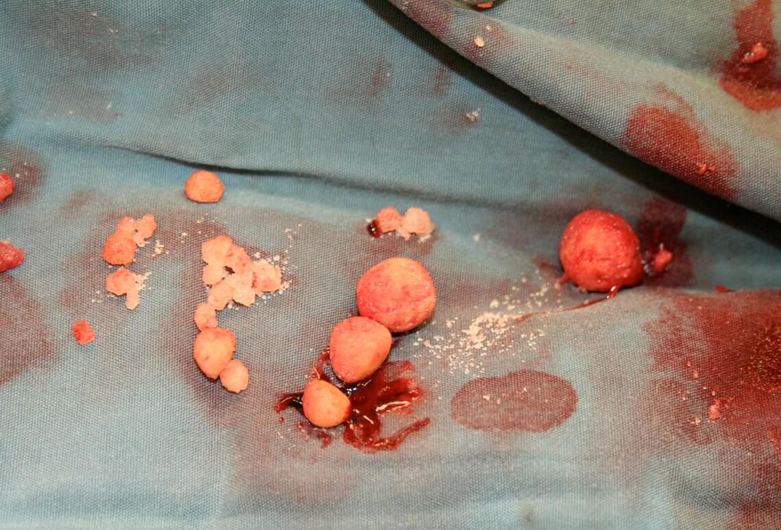 Bladder Stone Treatment in Delhi